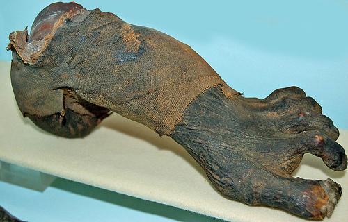 Mummified woman's crippled foot at the Semmelweiss Museum