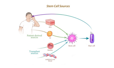 stemcell therapy