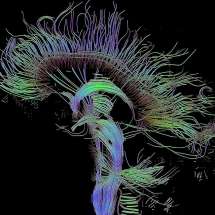 CS+Linguistics. An image of neural pathways in the brain taken using diffusion tensor imaging. Image by Thomas Schultz via Wikimedia Commons. 