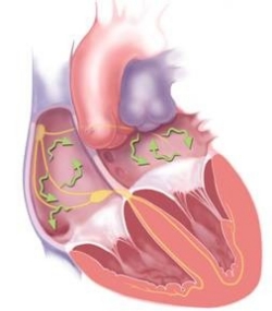 A medical image of a heart, indicating atrial fibrillation.