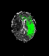 Imaging showing stroke-affected brain tissue