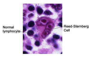 A visualization of a normal lymphocyte and a Reed-Sternberg Cell