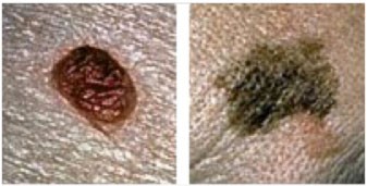 asymmetry melanoma symptoms