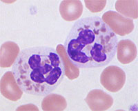 Neutrophils in Chediak-Higashi syndrome