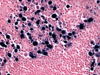 EBV in situ hybridization in Hodgkin transformation of CLL