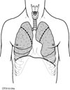 Typical areas of lung removed during LVRS