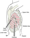 Incision placement for the thoracoscopic (VATS) approach to the operation