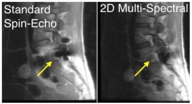 2D Multi-Spectral Imaging For Fast MRI Near Metal
