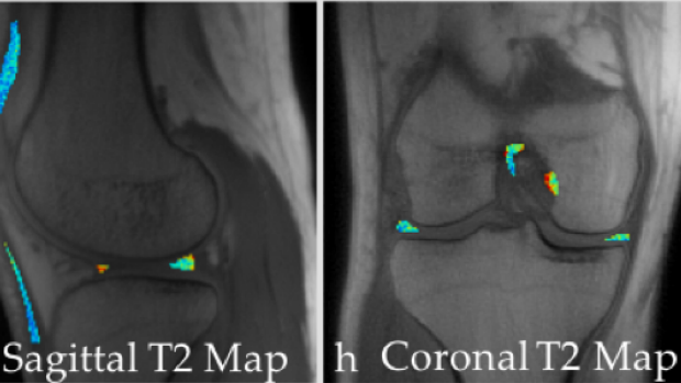 Imaging and T2 Relaxometry of Short-T2 Connective Tissues in the Knee using Ultrashort Echo-Time Double-Echo Steady-State (UTEDESS)