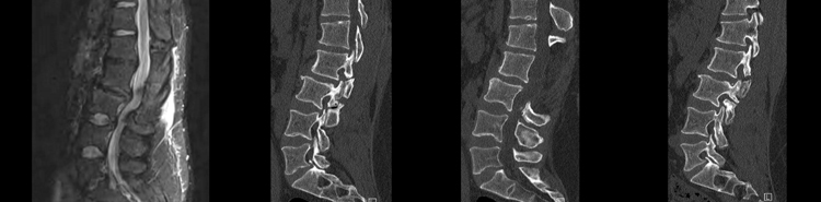 Division of Spine and Peripheral Nerve Surgery at Stanford