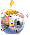 Electronic enhancement of tear secretion for treatment of Dry Eye