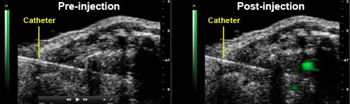 Ultrasound imaging of Pre- and Post-injection of nanoparticle laden cardiac stem cells