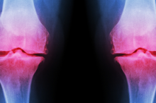 Graphic of knee joints lit up in red on an X-ray to indicate arthritis.