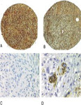 Apo D in soft tissue tumors: a novel marker for dermatofibrosarcoma protuberans