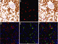 A landscape effect in tenosynovial giant-cell tumor from activation of CSF1 expression by a translocation in a minority of tumor cells 