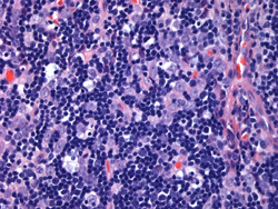 Thymoma WHO Type B2