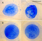 Examples of Lens Capsule Extraction, manual and laser-guided