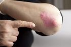 Possible psoriasis drug target identified